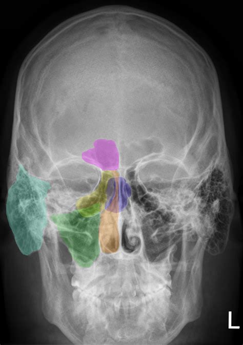 middle ear  sinus problems skybrary aviation safety
