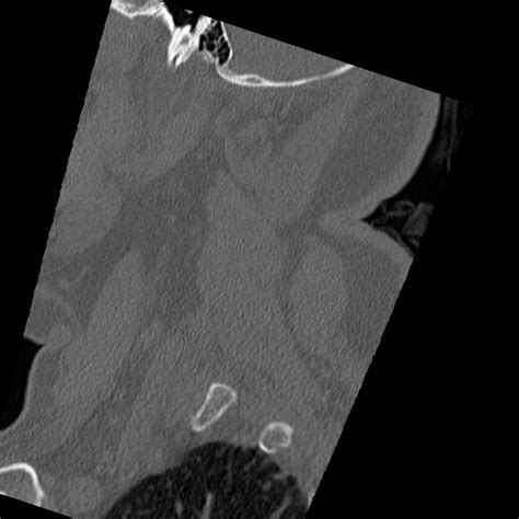 Cervical Spinal Neurofibroma In A Patient With Nf Radiopaedia