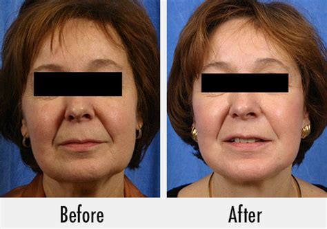 Top Facelift Plastic Surgeon in Detroit | Dr. Ali - Dr Ali