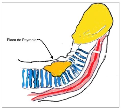 Doença De Peyronie Dr Marcelo Thiel