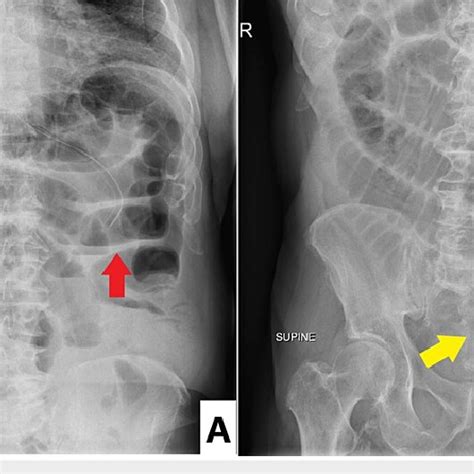 Abdominal X Ray In The Standing A And Supine B Positions Showing Download Scientific