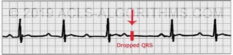 Second Degree Heart Block Ekg