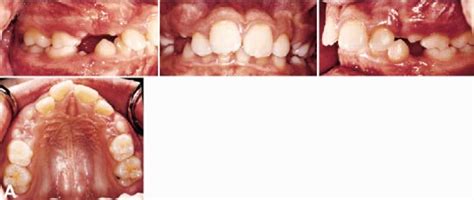 The Connecticut Intrusion Arch Jco Online Journal Of Clinical Orthodontics