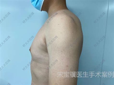 男性乳房肥大男性乳房肥大 好大夫在线