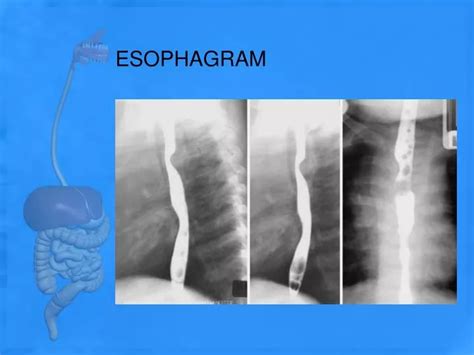 PPT - ESOPHAGRAM PowerPoint Presentation, free download - ID:3086985