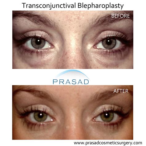 Transconjunctival Blepharoplasty Eyelid Surgery New York City