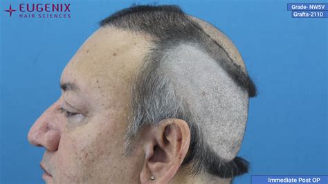 Norwood Scale 5v Baldness Hair Transplant And Treatment Uk