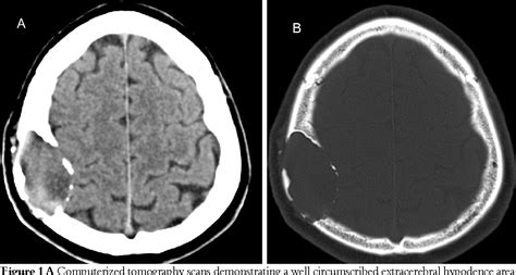 Pdf Intradiploic Epidermoid Cyst Of The Skull Intradiploic Epidermoid