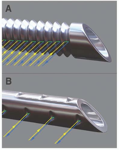 Advanced Ultrasound Guided Needle Technology Anesthesia Key