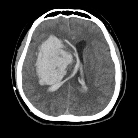 Lateral Basal Ganglia Hemorrhage Bgh In Computed Tomography Ct