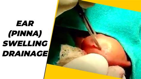 Huge Cyst Drainage Pseudocyst Ear Seroma Ear Incision And