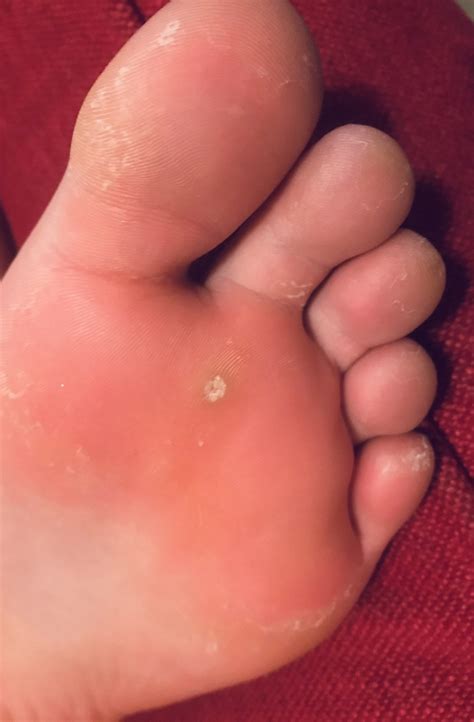 Verruca Treatment Options ⋆ Care For Feet