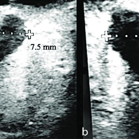 Optic nerve ultrasound. (a) Right optic nerve measuring 7.5 mm. (b ...