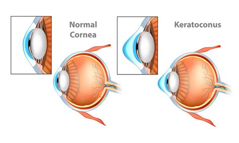 Keratoconus Eye Disease Symptoms Causes And Treatment