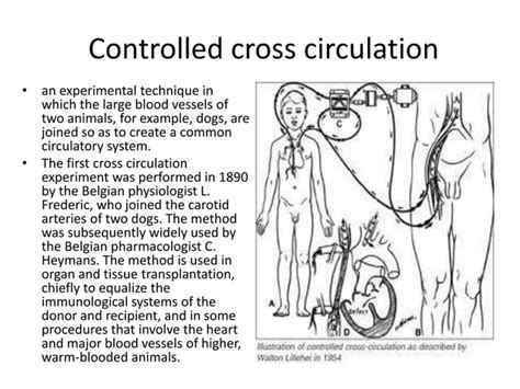 History of cardiopulmonary bypass