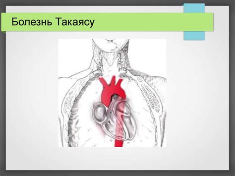 Болезнь Такаясу - презентация онлайн