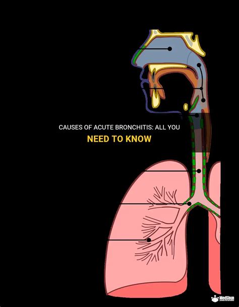 Causes Of Acute Bronchitis: All You Need To Know | MedShun