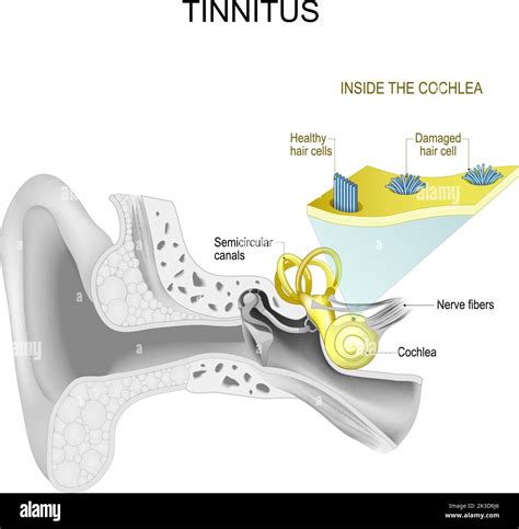 Tinnitus. Human ear. part of Auditory system. Inside the cochlea. Close ...