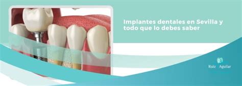 Implantes Dentales En Sevilla Duraci N Costos Y M S