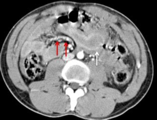 Blunt Trauma With Bowel And Mesenteric Injuries Radiology Cases