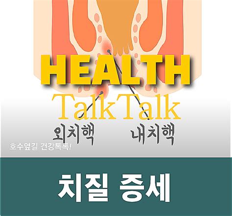 치질증세 1기~4기 단계별 증상과 치료 네이버 블로그