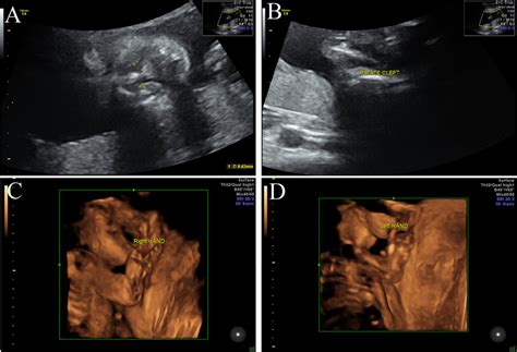 Bilateral Cleft Lip Ultrasound