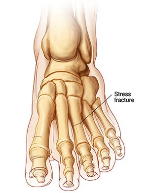 Stress Fracture Veterans Affairs