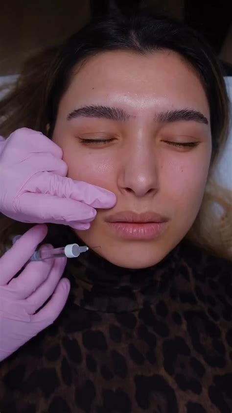 Lip Fillers Timelapse Expert Cosmetic Injections In London Honey Lips® [video] Cosmetic