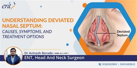 Deviated Nasal Septum Causes Symptoms Treatment Options