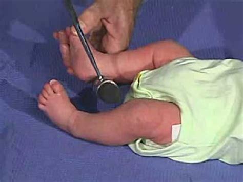 Physical Exam Newborn Normal Reflexes Deep Tendon Reflexes YouTube