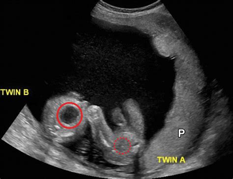 Identical Twins Ultrasound 12 Weeks