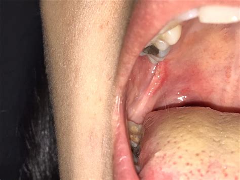 26yo Fever Of Five Days Of Evolution With Lesions In The Oral Cavity