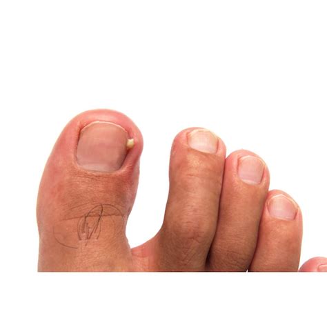 Ingrown Toenails — Podiatry Group Of Annapolis P A