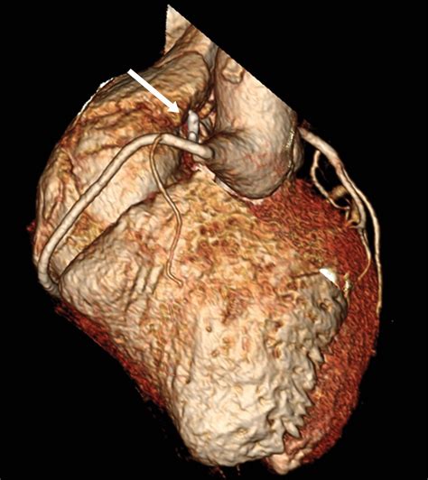 Coronary Artery Fistulas Pathophysiology Imaging Findings And