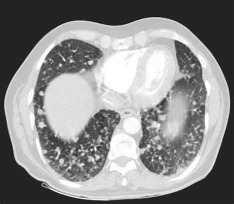 Papillary Thyroid Cancer Ct Wikidoc