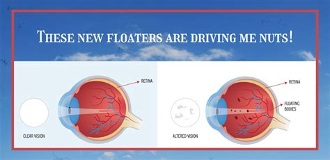 What To Do About Those Pesky Floaters Eye Doctor Optometrist