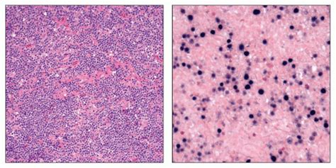 T Cell Histiocyte Rich Large B Cell Lymphoma Basicmedical Key