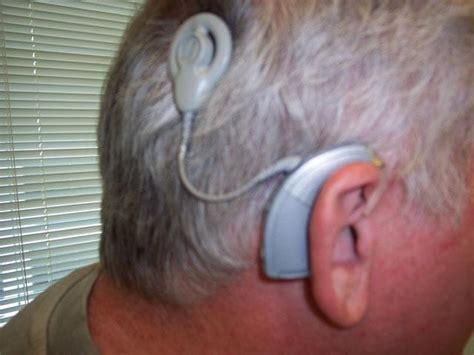 Unilateral Cochlear Implants Market Raising The Business