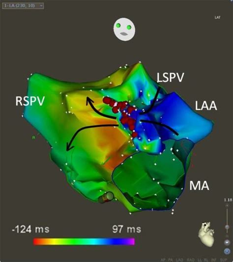 Atrial Tachycardia: Diagnosis and Treatment - Dermatology Advisor