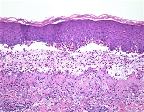 Dermatitis Herpetiformis Histology