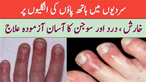 Chilblains Sehrai S Crafts Swollen Hands And Fingers In Winter