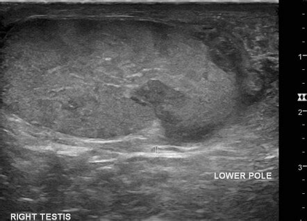 Testicular Rupture Radiology Case Radiopaedia Org