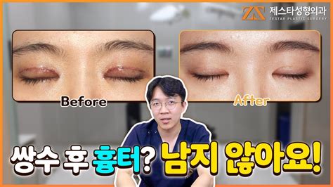 쌍꺼풀 수술 후 흉터 매몰법이든 절개법이든 문제 없어요 ㅣ제스타 성형외과 Youtube