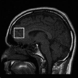 T1-weighted sagittal MRI location for anterior cingulate/medial... | Download Scientific Diagram