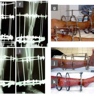 PDF The Use Of Twin Ring Ilizarov External Fixator Constructs