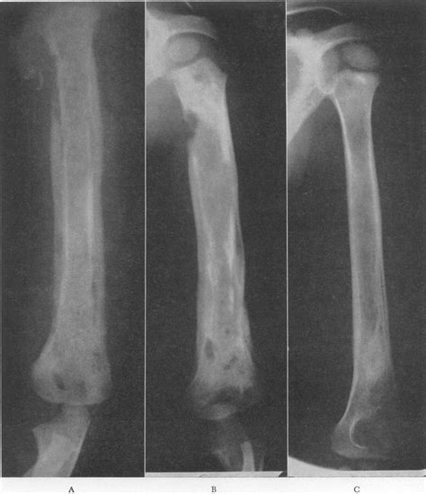 Osteomyelitis In Sickle Cell Disease Captions Energy