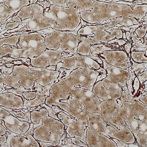 Histopathology From Liver Tumor Demonstrates Hepatocellular Carcinoma Download Scientific