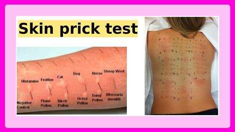 Skin Prick Test YouTube