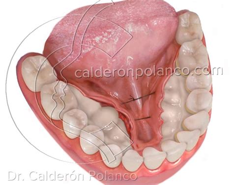 Dr Javier Calderón Polanco Torus y Exóstosis