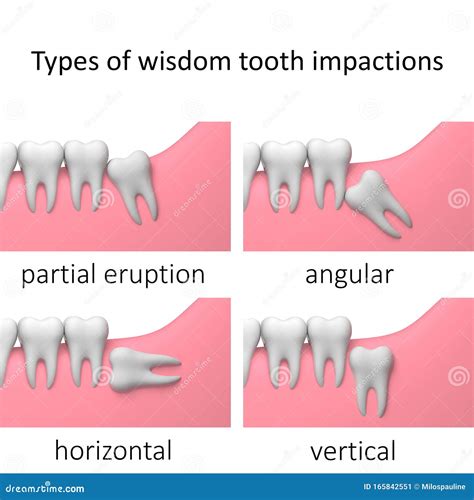 Types of Wisdom Tooth Impactions, White Background, Collage, 3D-render ...